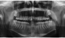 x-ray of a jaw from the front